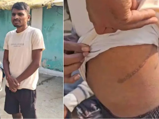 किडनी विक्रीमागे आंतरराष्ट्रीय टोळी कार्यरत असल्याचे उघडकीस !