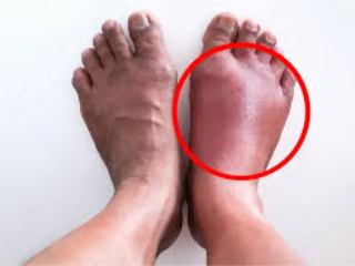 शरिरावर सूज येण्याची कारणे आणि त्याचा शरिरावर होणारा परिणाम !